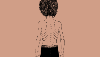 Illustration of an emaciated child